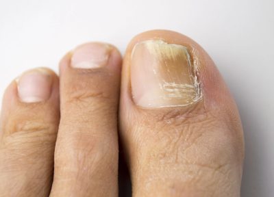 Schimmelnagel, schimmelnagels, fungus toenail