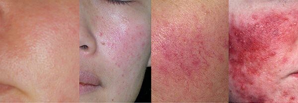 Vormen, verschillende typen rosacea