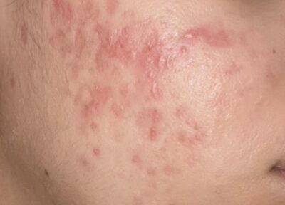 PIE rode acne littekens